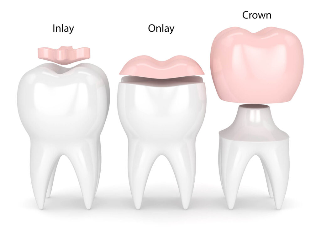 Crowns Inlay Onlays Peachcroft Dental Surgery Crowns Inlay Onlays Peachcroft Dental Surgery